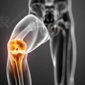مدیریت بیماری آرتروز نکات و درمان‌ها