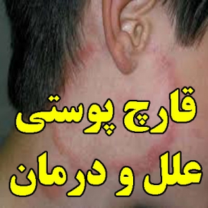 قارچ پوستی، علل و درمان