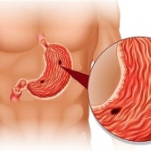 پرستاری مراقبت از التهاب مخاط معده PPT