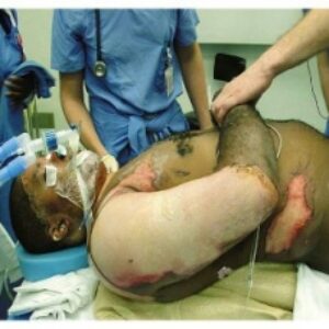کنترل عفونت در ICU