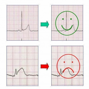 تفسیر کامل ECG