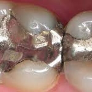 ترمیم آمالگام(Amalgam restoration  )