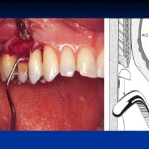 پاورپوینت آماده ارائه و تدریس فلپ های پریودنتال(Periodontal  flaps)