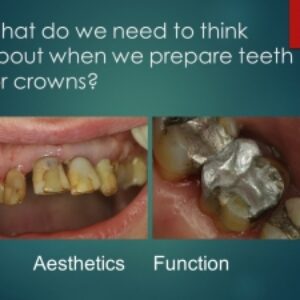 پاورپوینت تدریس اصول آماده سازی دندان(Principles of tooth preparation)