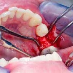 پاورپوینت آماده کنفرانس تکنیک جراحی لثه(Gingival Surgical Technique)