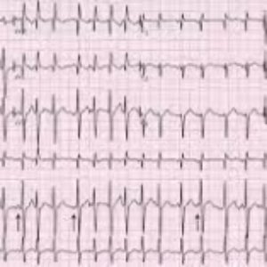 پاورپوینت آماده تدریس و ارائه تفسیر مقدماتی نوار قلب (Preliminary interpretation of ECG)
