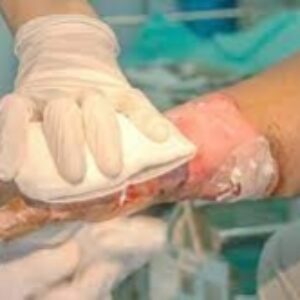 پاورپوینت آماده کنفرانس و برگزاری کارگاه آموزشی سوختگی و اقدامات پرستاری (Burns and nursing measures)