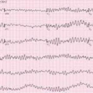 پاورپوینت آماده تدریس و برگزلری کارگاه مدیریت برادی کاردی و تاکی کاردی علامت دار(Management of Symptomatic Bradycardia and Tachycardia )