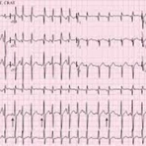 پاورپوینت آماده تدریس و برگزلری کارگاه مطبقه بندی تاکی آریتمی ها (Classification of  tachyarrhythmias )
