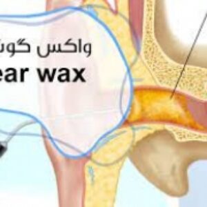 واکس گوش(Ear Wax)