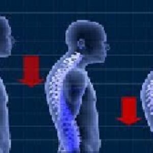 دانلود تحقيق در مورد قوز كمر ، شايع ترين ناهنجاري ستون فقرات