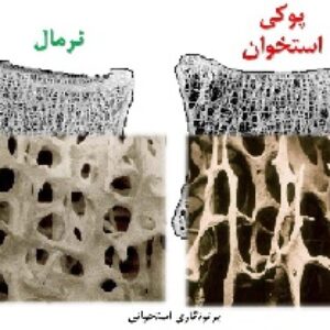 پاورپوینت درباره پوکی استخوان