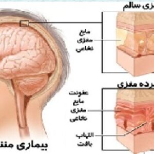 باوربوینت درمورد درمان بیماران مبتلا به عفونت های عصبی