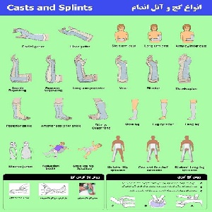 پوستر گچ گیری شامل انواع آتل و گچ