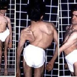 همه چیز در باره بیماری دیستروفی عضلانی دوشن