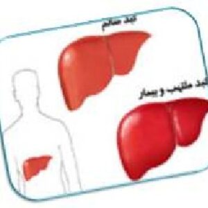 پاورپوینت هپاتيتB  و C وA