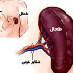 پاورپوینت سرطان طحال