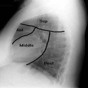 pulmonary edema(ادم حاد ریه)