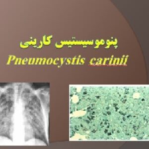Pneumocystis carinii پنوموسیستیس کارینی
