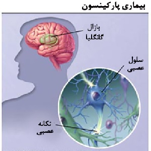 پاورپوینت کامل و جامع با عنوان بیماری پارکینسون (Parkinson) در 59 اسلاید